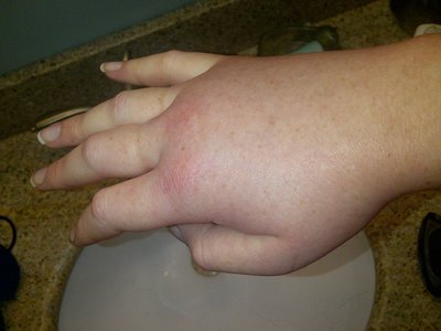 Hand with signs of hereditary angioedema